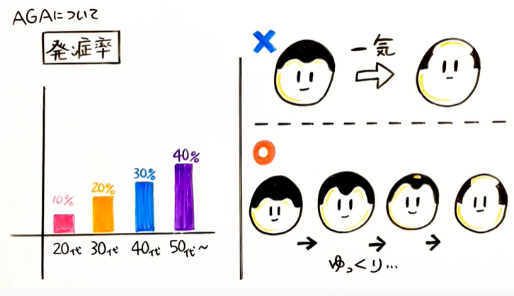 年代ごとのAGA発症の割合