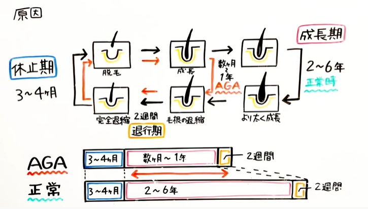 通常のヘアサイクルとAGAのヘアサイクル