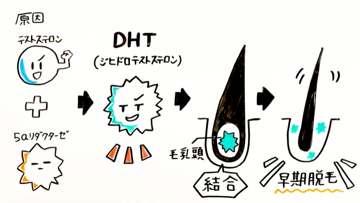 ヘアサイクルが乱れ、AGAを発症するメカニズム