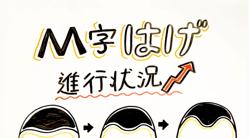 M字はげの進行状況