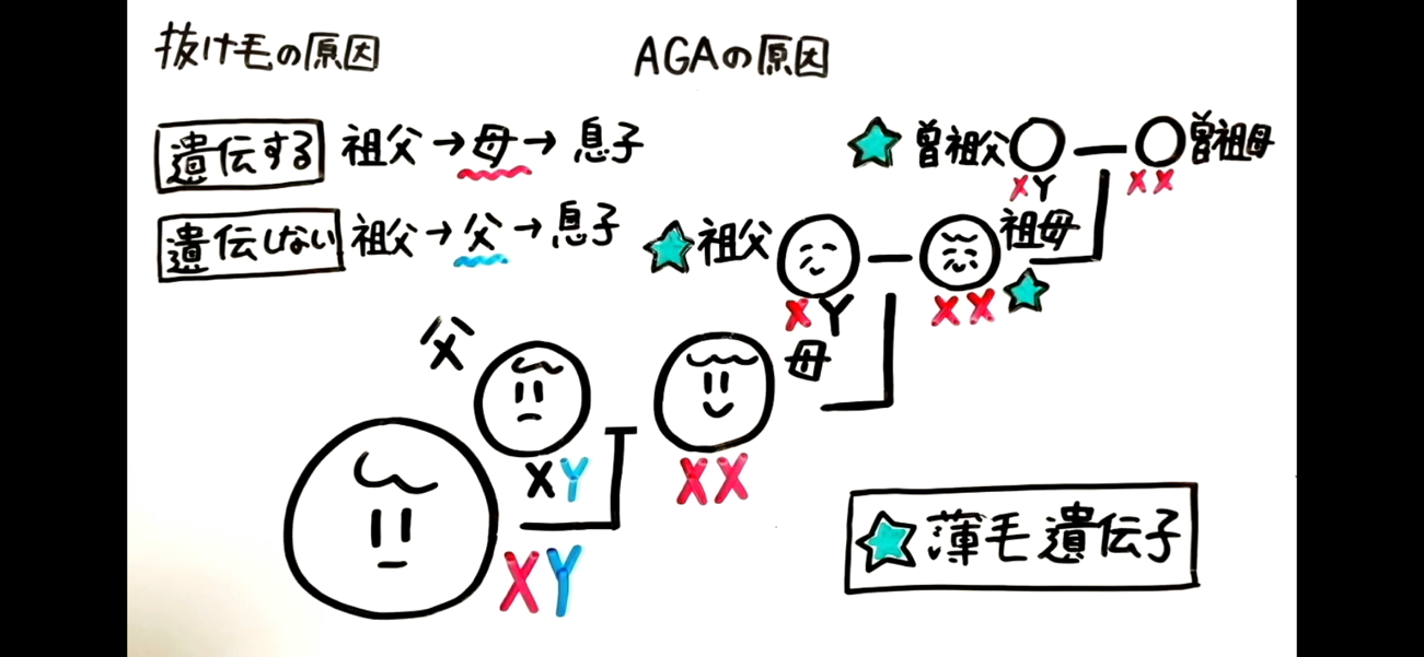 AGAの原因