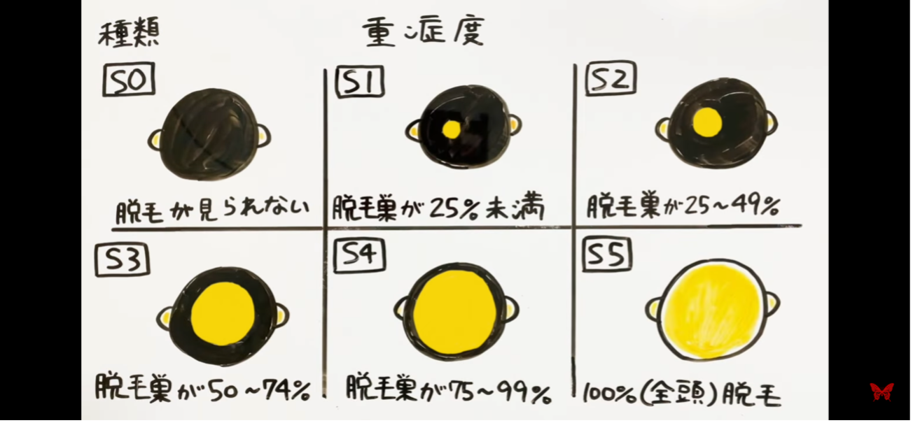 円形脱毛症の重症度