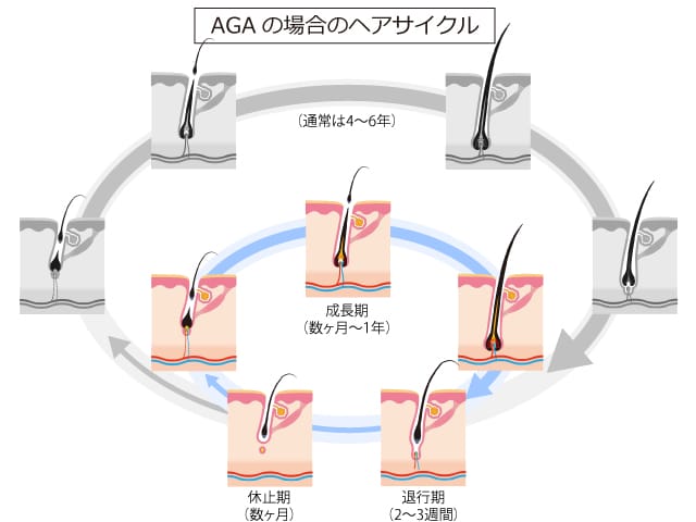 サムネイル:AGAの場合のヘアサイクル