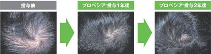 サムネイル:データでわかる!プロペシアの効用