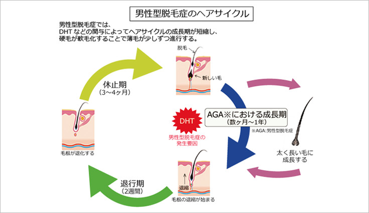 男性型脱毛症のヘアサイクル