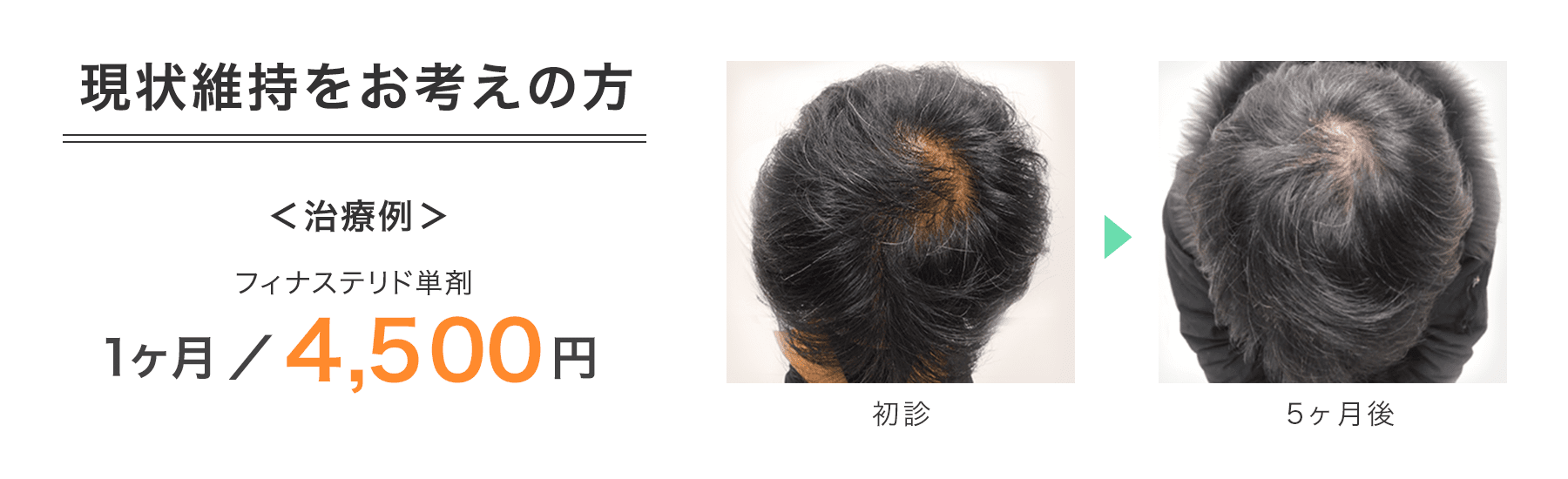 現状維持をお考えの方 ＜治療例＞ フィナステリド単剤 1ヶ月／4,500円