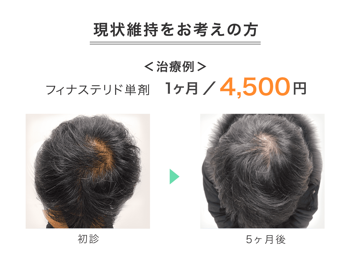 現状維持をお考えの方 ＜治療例＞ フィナステリド単剤 1ヶ月／4,500円